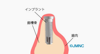 インプラントを埋め入れる