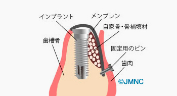 自家骨または骨補填剤を入れ、人工メンブレンで覆う