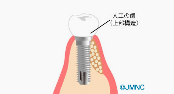 人工の歯を装着