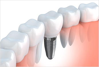 こんなお悩みをお持ちの方にインプラント治療をお勧めします。