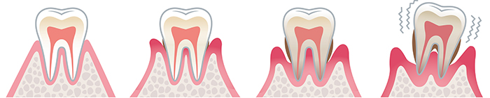 歯周病の進行